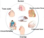 ⁦Correcteur Et Ort-hèse De Pied – Blanc⁩ - الصورة ⁦6⁩